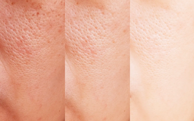 Peau sèche ou déshydratée ?