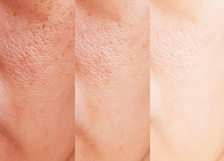 Peau sèche ou déshydratée ?