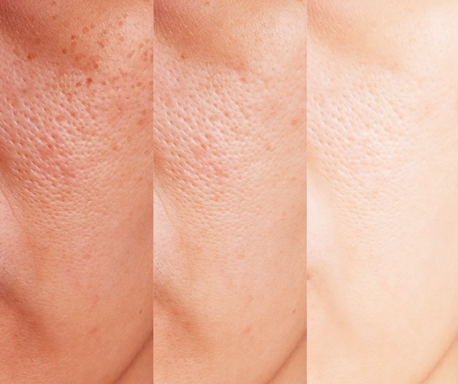 Peau sèche ou déshydratée