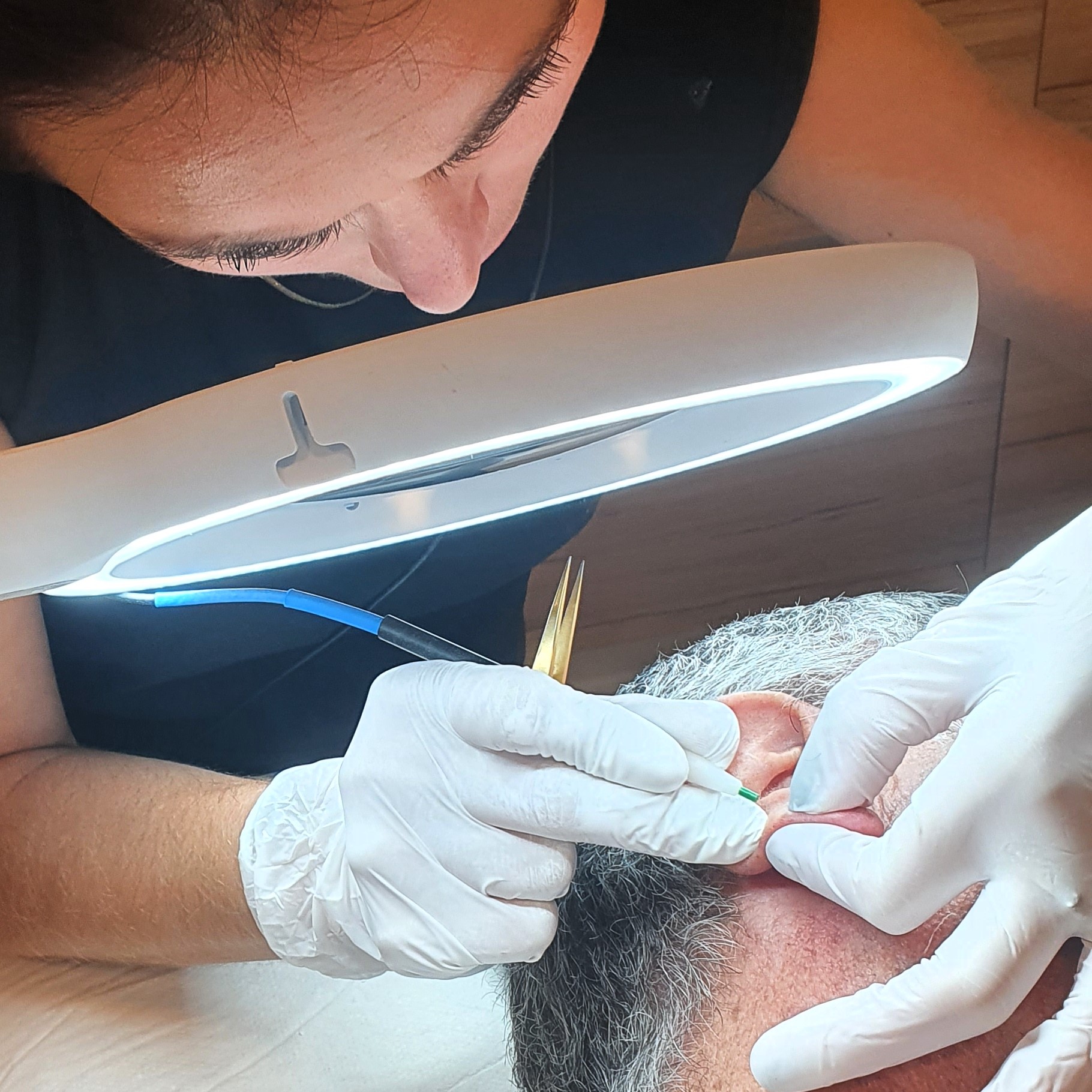 epilation définitive oreilles