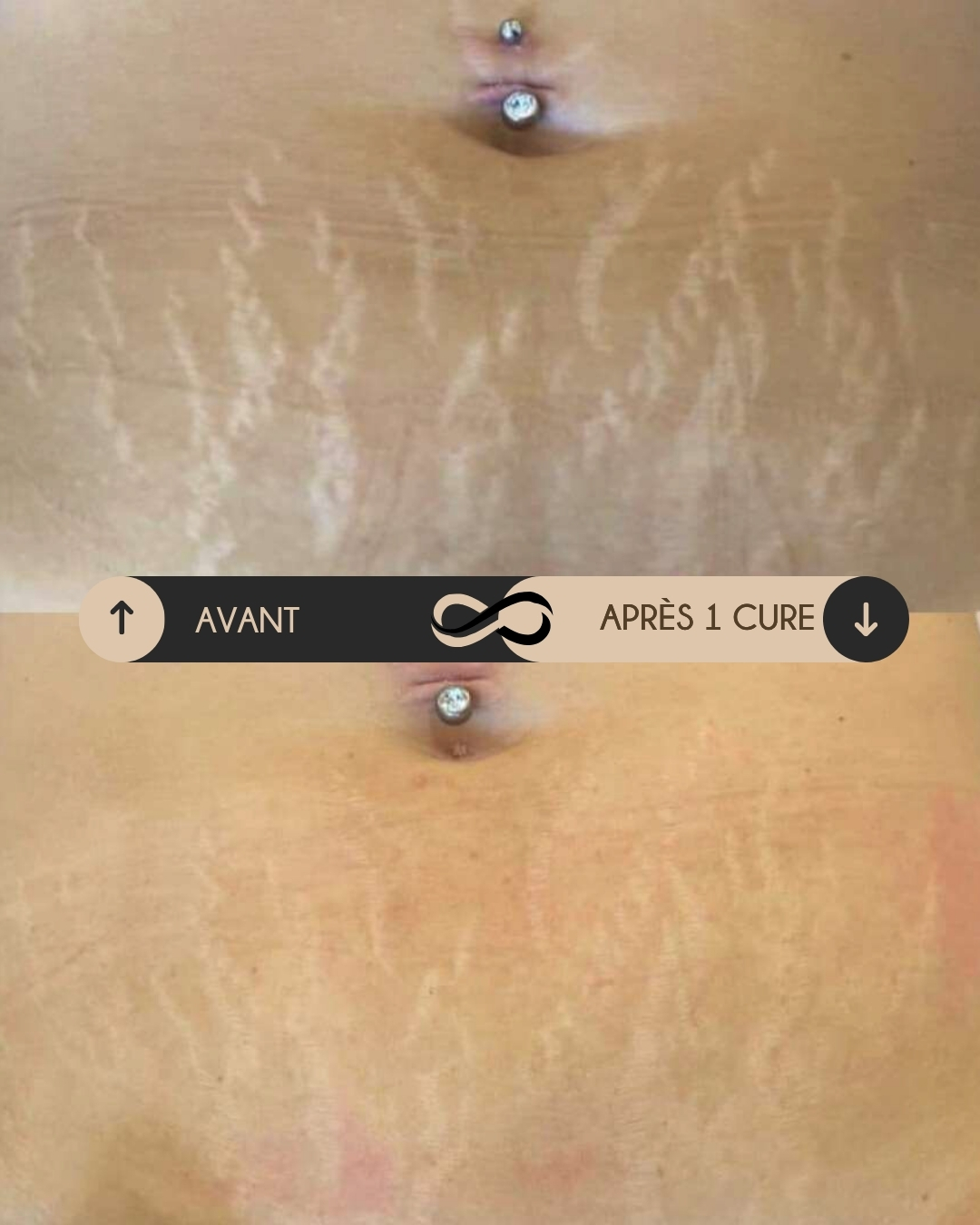 Avant le protocole correctif des vergetures